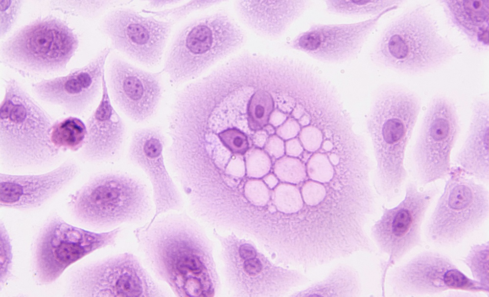 Sunitinib (Sutent)