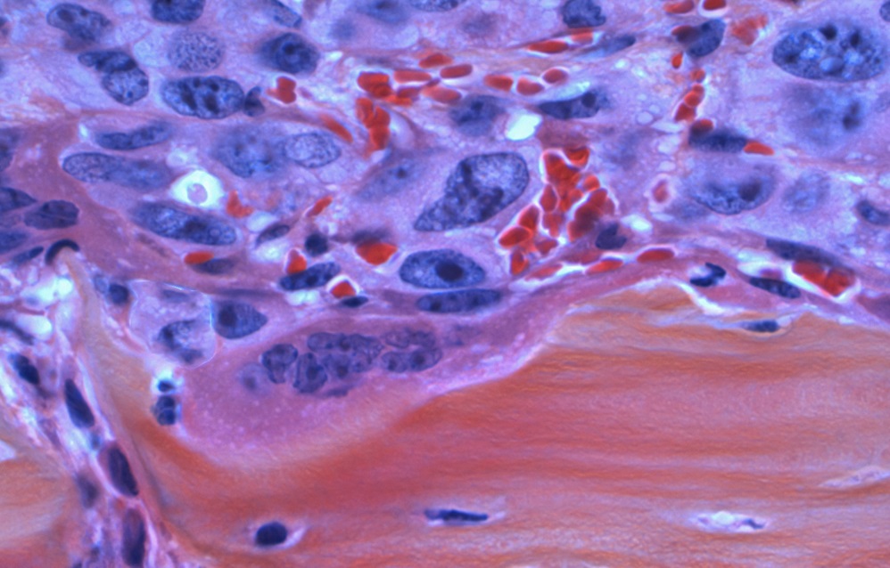 Erlotinib (Tarceva)