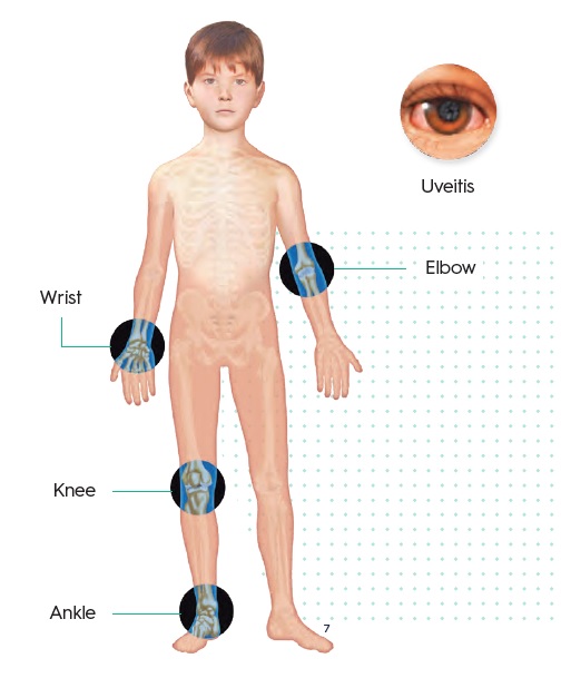 Artritis idiopática juvenil: síntomas y tratamiento.